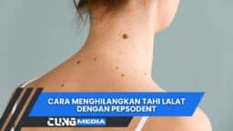 Cara Menghilangkan Tahi Lalat Dengan Pepsodent