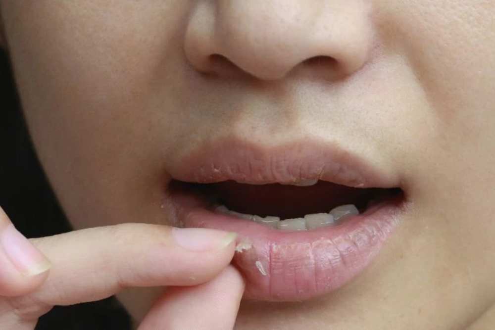 5 Penyebab Bibir Kering dan Gelap yang Harus Anda Ketahui!