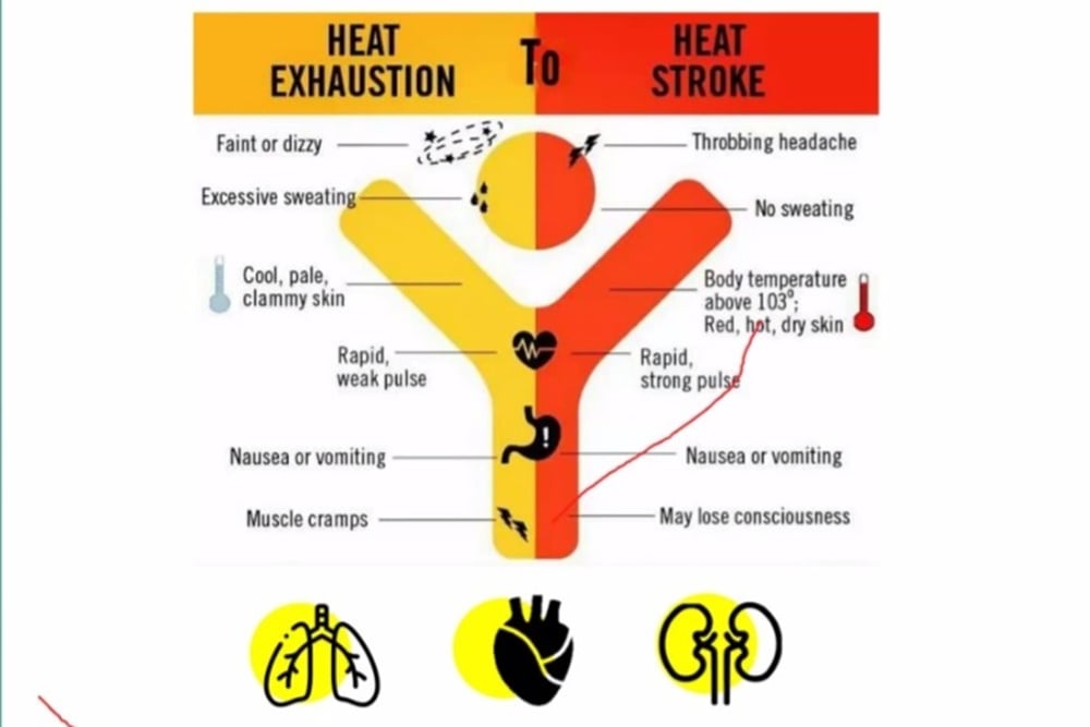 Perempuan Alami Heatstroke Usai Sauna 45 Menit, Ini Penyebabnya!